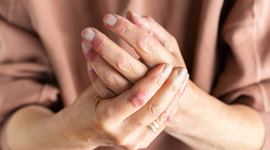 A person's hands with a skin condition like eczema